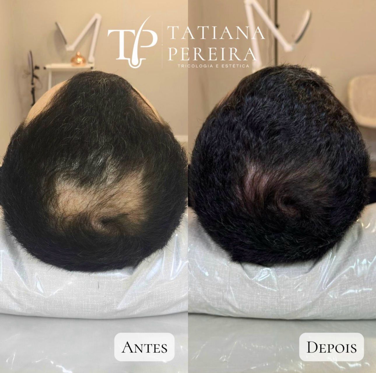 Resultado tratamento queda capilar masculina — paciente 1