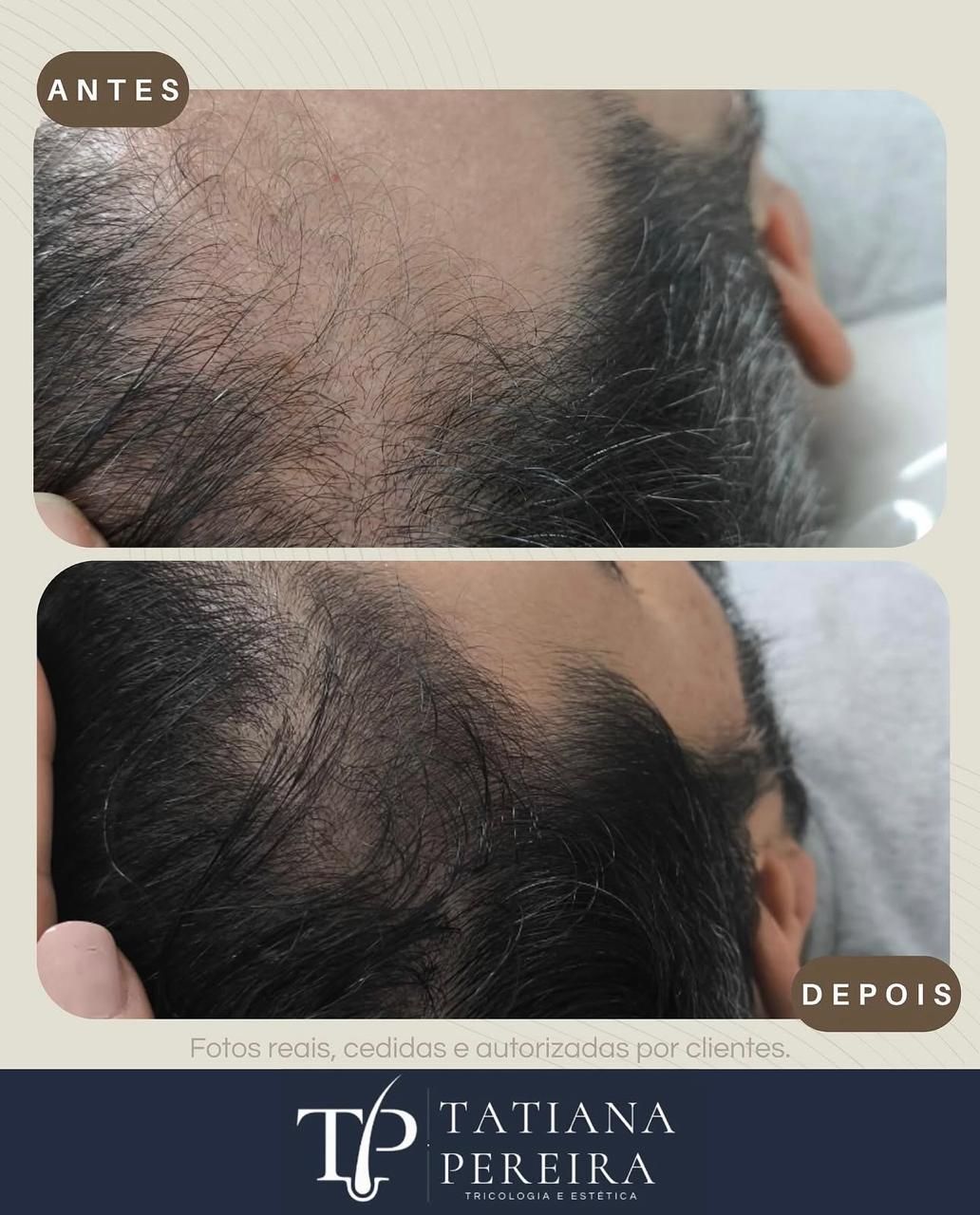 Resultado tratamento queda capilar masculina — paciente 6